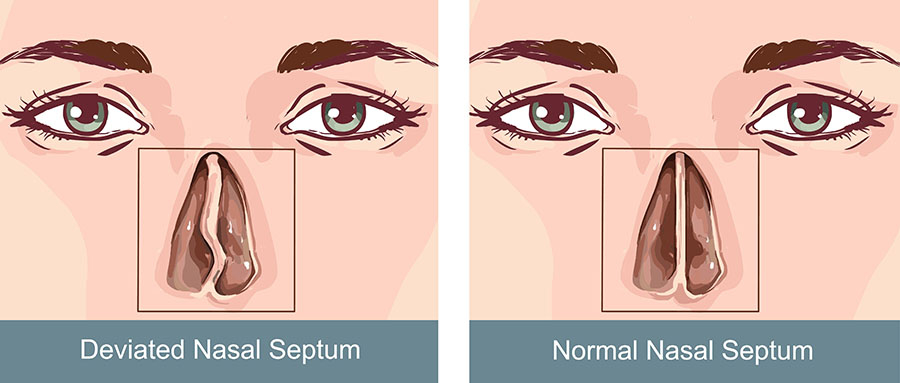 Nasal Septum Treatment